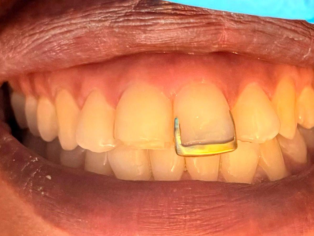 Close-up of a patient's smile with a gold restoration on a front tooth