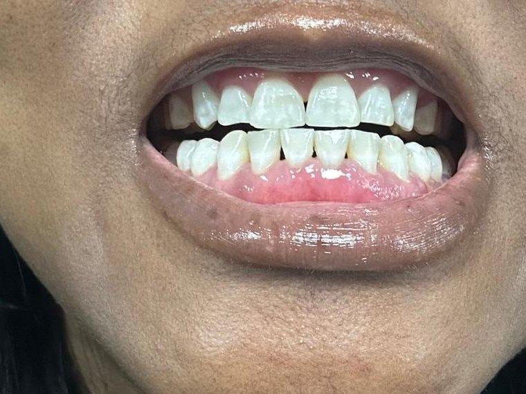 Close-up of a patient's smile