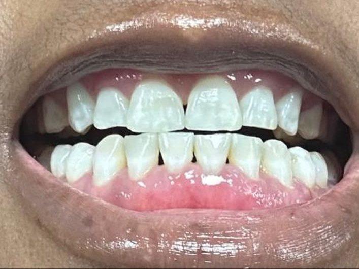 Close-up of a patient's smile